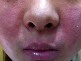 激素脸图片,激素脸怎么排激素?