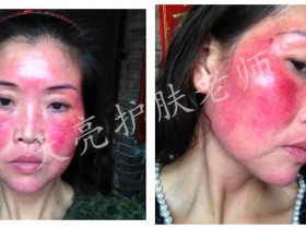 不看后悔!激素脸怎么办?如何彻底修复好激素脸?我修复激素脸的亲身经历分享