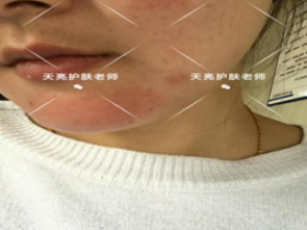 天亮美肤-吴娟激素脸修复案列